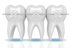 Брекет-система: прием ортодонта и этапы лечения