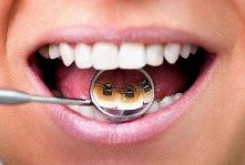 Различия видов брекетов по расположению на зубе