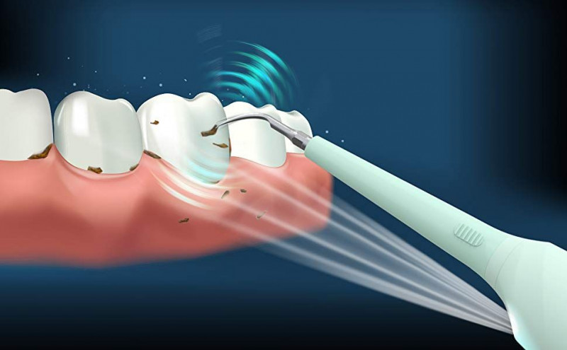 Снятие твердых зубных отложений ультразвуком